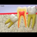 All you need to know about the eruption of a wisdom tooth