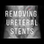 Removing Ureteral Stent in 15 Seconds #shorts