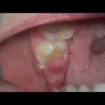 what's this sore gum on wisdom tooth – pericoronitis