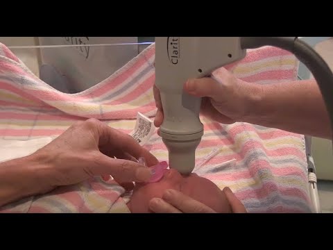 Eye test for Retinopathy of Prematurity
